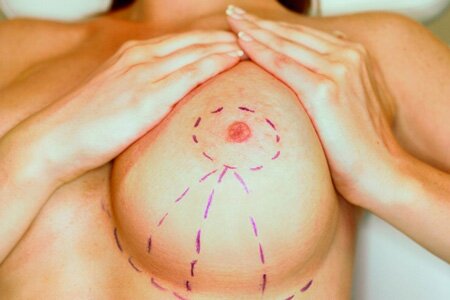 Підтяжка грудей проводиться з метою відновлення привабливої ​​форми, оптимального обсягу і правильного положення грудей, втрачених в результаті пологів і годування грудьми, вікових змін, гормональних порушень, а також різких стрибків маси тіла